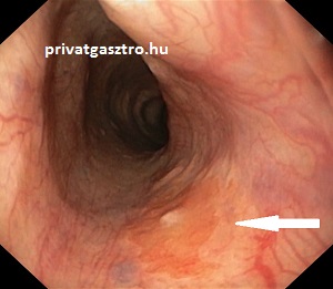 heterotópiás gyomornyálkahártya a nyelőcső felső végén