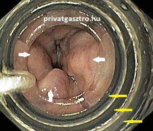 oesophagus varix ligatio gastroscopia